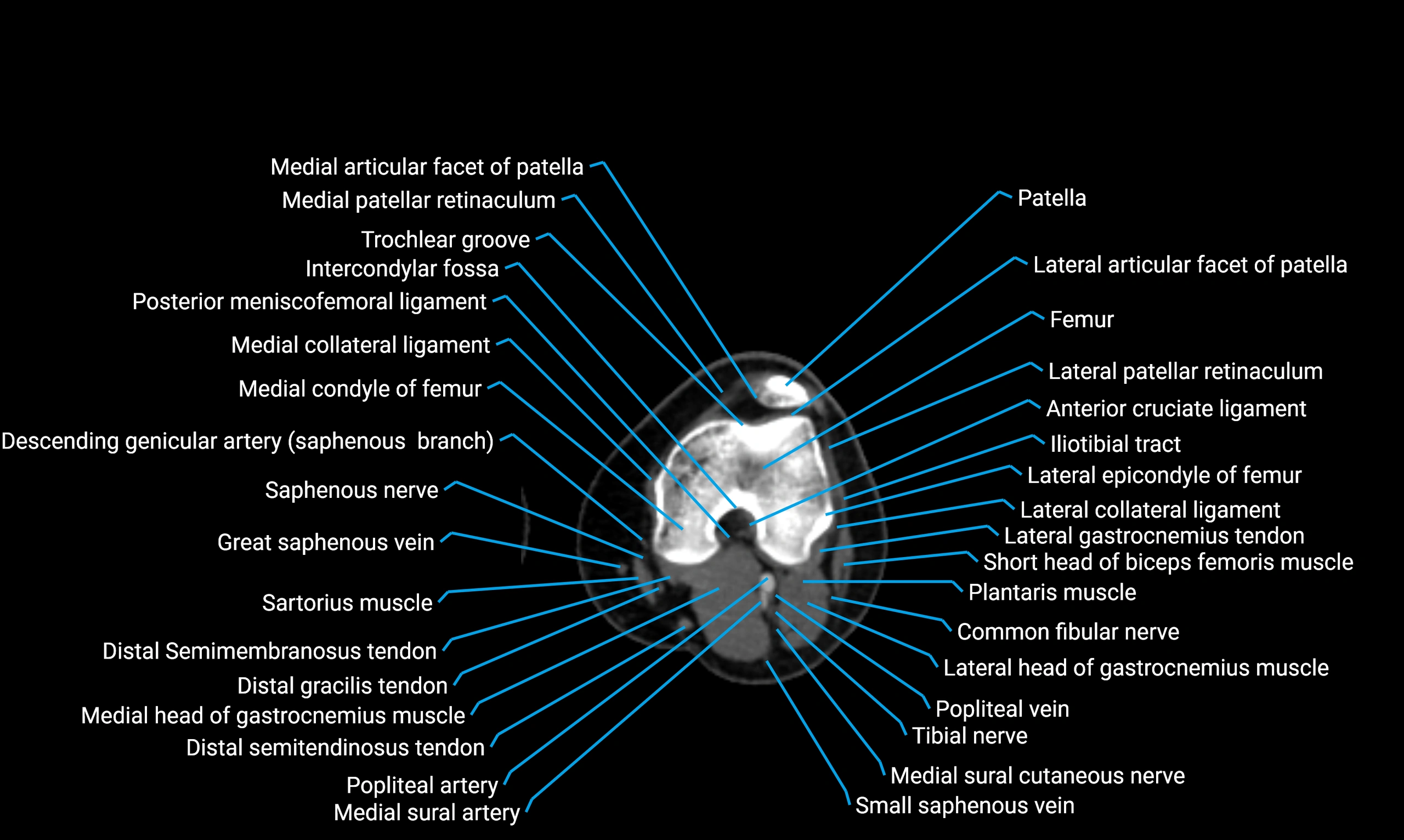 CT thigh axial cross sectional anatomy labelled image_86 (2).webp